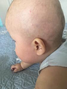 受益法轮功 折磨婴儿的罕见皮肤病彻底痊愈
