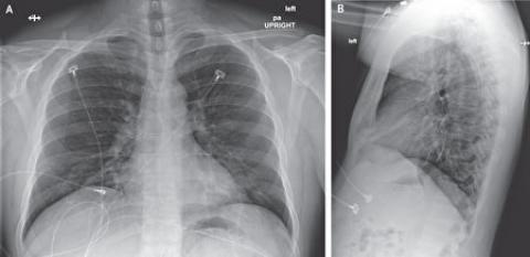 在住院第3天（患病第7天），患者的X光胸片看起来依旧没有异常。（NEJM）