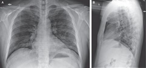 在住院第6天（患病第10天），第四次胸部X射线照片显示两个肺部都出现基底条状混浊，症状与非典型肺炎相符。（NEJM）
